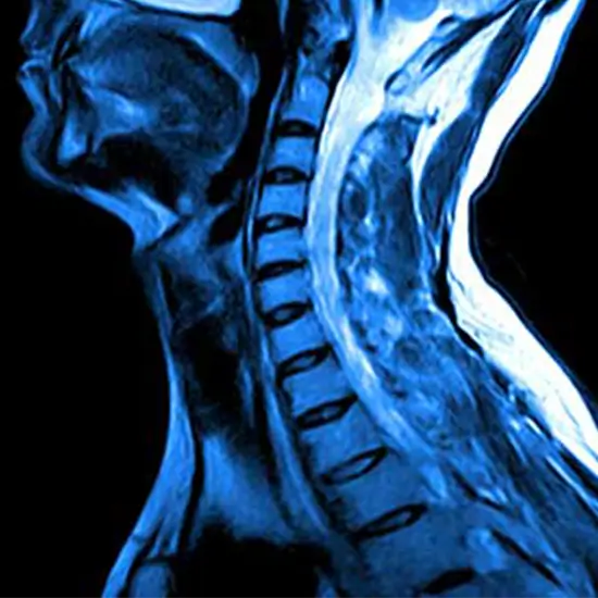 MRI Cervical Lumbar Spine